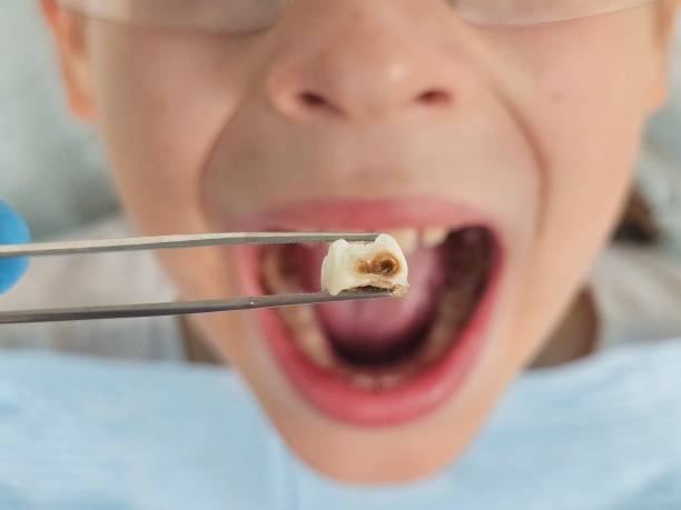Best Emergency Root Canal Therapy in Princess Anne, MD